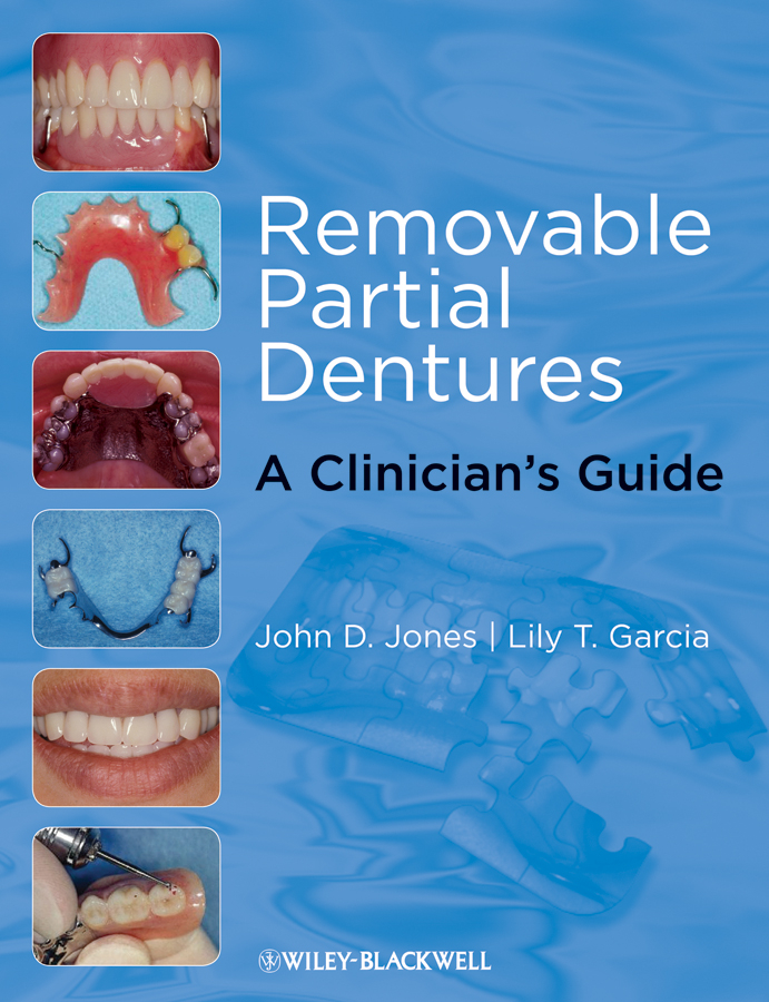 E-book, Removable Partial Dentures : A Clinician's Guide, Blackwell