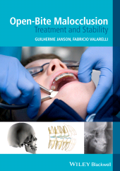 E-book, Open-Bite Malocclusion : Treatment and Stability, Blackwell