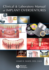 E-book, Clinical and Laboratory Manual of Implant Overdentures, Blackwell