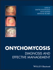 E-book, Onychomycosis : Diagnosis and Effective Management, Blackwell