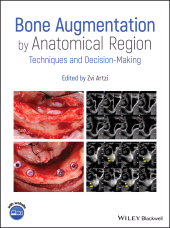 E-book, Bone Augmentation by Anatomical Region : Techniques and Decision-Making, Wiley